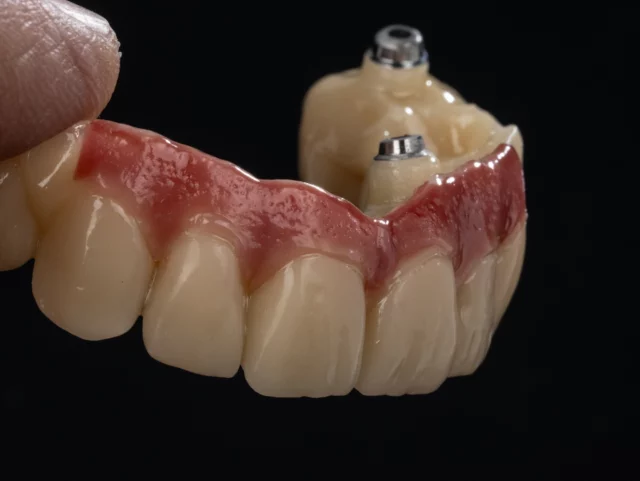 ➜ Endlich Feierabend!
Hier eine PMMA „Test-Drive“ -Brücke für morgen früh:
•	Gefertigt aus ARGEN P PMMA, einfarbig
•	Gefräst mit ARGEN HD-milling/ Dyamach
•	Gingiva gestaltet mit GC GRADIA PLUS  Gum
•	Veredelt mit Panther Polymer
Mal sehen wie der Tag Morgen startet…. 😀