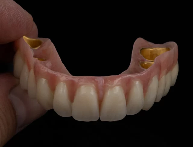 A case from this morning! ✨
➜ A complex case featuring zirconia primary double-crowns on teeth and implants – with very limited space in the buccal area. 💥 Dental work CDT Merlin from Team Sirius and I.

Everything glued intraorally for maximum precision and stability. The visible gingival areas were carefully individualized with GC GRADIA PLUS and beautifully finished using Panther Polymer – for a truly lifelike result.
.
Materials & tools used: ARGEN zirconia ORYX diamonds
HELIOFORM® electroplated gold
GC GRADIA PLUS Gum GC OPTIGLAZE color Smile Line instruments Candulor AESTHETIC ...and, of course, tons of passion and attention to detail 💯
#ARGEN #GCGRADIAPLUS #GRADIA #GCGermany #ARGEN_Z_Highlights #optiglaze #masterclassbycarstenfischer #siriusceramics #pantherpremiuminstruments #pantherpolymer 🖤