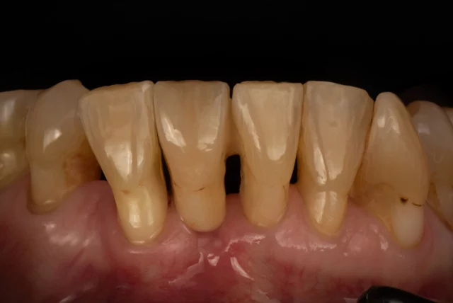 ➜The Lost Front Tooth – Impressions from Last Week
The ingredients for this result: Zirconia: ARGEN HT+ ML Colour recipe: Matisse Shade Matching AI GC Initial IQ Lustre Pastes ONE GC Initial Zr-FS DEKEMA furnace performance Panther Polishing Instruments SMILE LINE Instruments
A huge THANK YOU to my team – because just teamwork makes the dream work! Core performance by CDT Naomi
Clinical: Team Your-Smile, Dr. Rafaela Jenatschke
. . . . . #masterclassbycarstenfischer #GCInitial #ARGEN #ARGEN_Z_Highlights #pantherpremiuminstruments #siriusceramics #GCGermany #DEKEMA