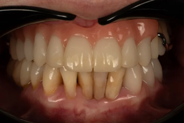 Im CAD/CAM-Workflow sprechen wir oft über navigierte Implantologie, perfekte finale Versorgungen und High-End-Passungen. Ja, das fasziniert mich sehr!

Für mich beginnt jedoch echter Fortschritt bereits viel früher.

Er beginnt mit der Würde des Menschen.
Mit seiner Geschichte.
Mit dem Wunsch, sich im Spiegel wiederzufinden.

Viele Patienten hängen an ihrer ursprünglichen Zahnform, weil sie Teil ihrer Identität ist. Wenn wir sie auf einem langen Behandlungsweg mitnehmen wollen, darf genau das niemals verloren gehen.

➜ Die Interimsversorgung ist deshalb weit mehr als eine Übergangslösung.
Sie ist Vertrauen.
Sie ist Orientierung.
Sie ist emotionale Sicherheit.

Dass wir heute individuelle Zahngarnituren und sogar die Ausgangssituation des Zahnfleisches so präzise kopieren können, ist für mich eine der größten Errungenschaften im digitalen Workflow. Das ist für mich wahrer Fortschritt.

➜ Inventarliste:
Blank: ARGEN P Multi (für dauerhaften Verbleib im Mund zugelassen)
Dyamach DS1 Plus
GC OPTIGLAZE color
Panther Polymer 
Smile Line Instruments