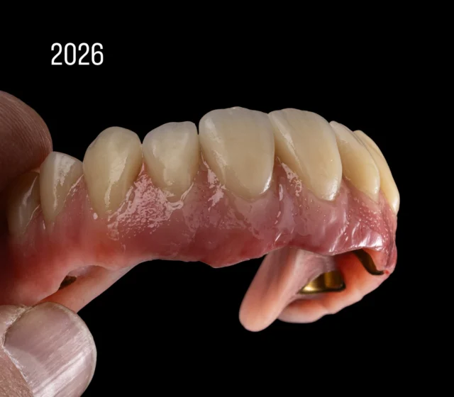 15 Jahre!  Diese Arbeit habe ich 2011 mit meinem Team das erste Mal gefertigt.
Galvano-Prothetik auf keramischen Primärteilen, auf zahn und Implantat → damals Stand der Technik. Heute? Immer noch Stand der Technik und beeindruckend.
Zwei Implantate sind dazugekommen. Die Versorgung musste neu werden.
Was sich verändert hat: Ästhetik (z. B. moderne Gingivamaterialien wie GC GRADIA PLUS Gum) → Möglichkeiten im Detail
Was sich nicht verändert hat: → Handwerk → Präzision → Erfahrung
Und genau das wird immer seltener.
Der Preis von damals? →Heute nicht mehr im Ansatz darstellbar.
Der Anspruch? Unverändert hoch.

Zahntechnik ist also nicht nur ein  Produkt → Es ist Können und bleibt es auch. 
@merlinski Danke für Deinen Einsatz zusammen mit mir und dem gesamten Team! 🙌🏻
Und natürlich die Praxis your-smile die bereits 2011 die Arbeit mit uns gerockt 🎸hat! Toll! 

Verwendete Materialien & Tools:
ARGEN Zirkonoxid
ORYX Diamanten, Sirius Ceramics
HELIOFORM® Galvanogold
GC GRADIA PLUS Gum
GC OPTIGLAZE Farben
Smile Line Instrumente
Ivoclar/ Candulor AESTHETIC
.
#ARGEN #GCGRADIAPLUS #GRADIA #GCGermany #ARGEN_Z_Highlights optiglaze masterclassbycarstenfischer siriusceramics pantherpremiuminstruments pantherpolymer 🖤